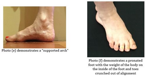 A supported arch and a pronated foot