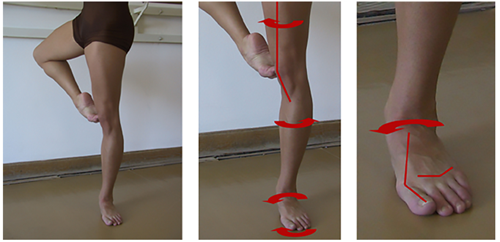 An example of a dancer with hyperpronation of the foot