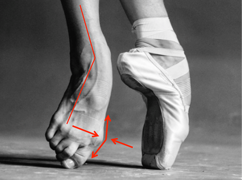 Example of winging with one foot bare and one in shoe