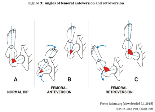 Diagram showing angles of femoral anteversion and retroversion