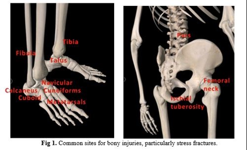 Diagrams of common sites for bony injuries