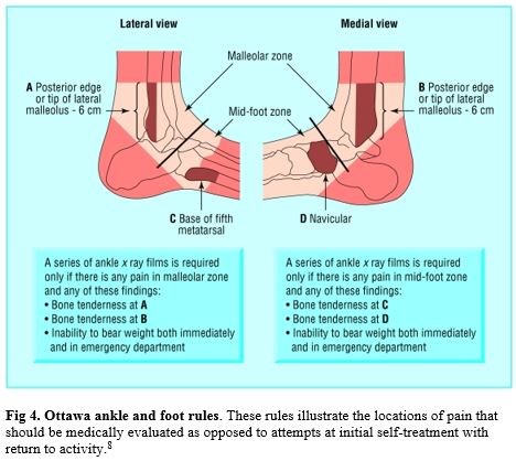 Diagram of Ottawa ankle and foot rules